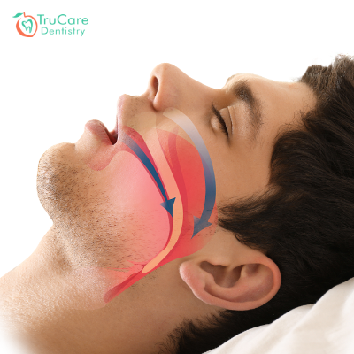 Sleep apnea treatment