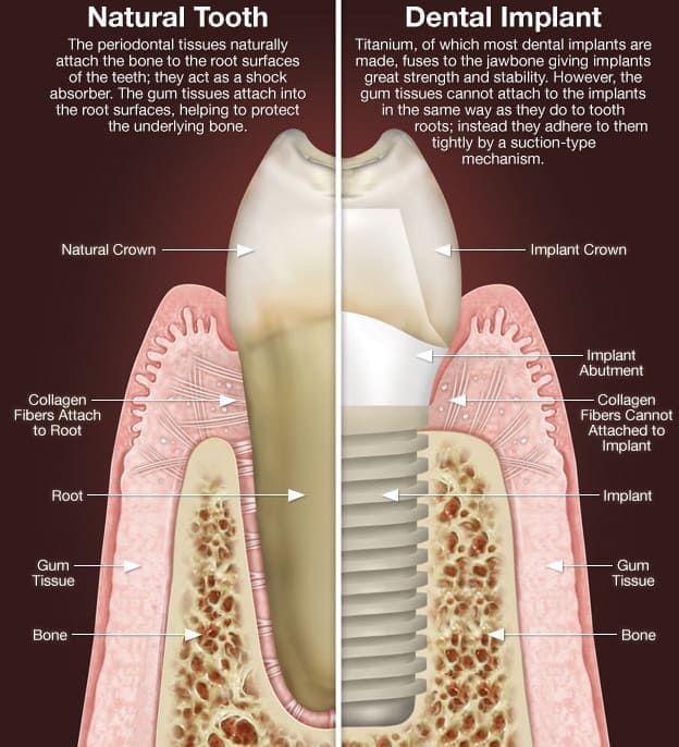 Dental Implant Roswell GA