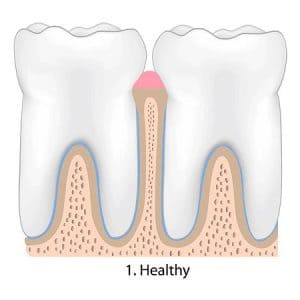 gum disease Treatment Roswell GA