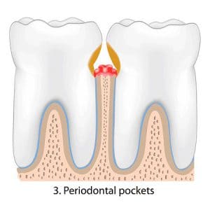 gum disease Treatment Roswell GA