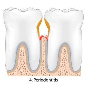 gum disease Treatment Roswell GA