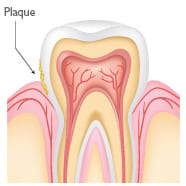 Periodontal Treatment Roswell GA