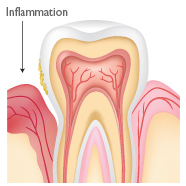 Periodontal Treatment Roswell GA